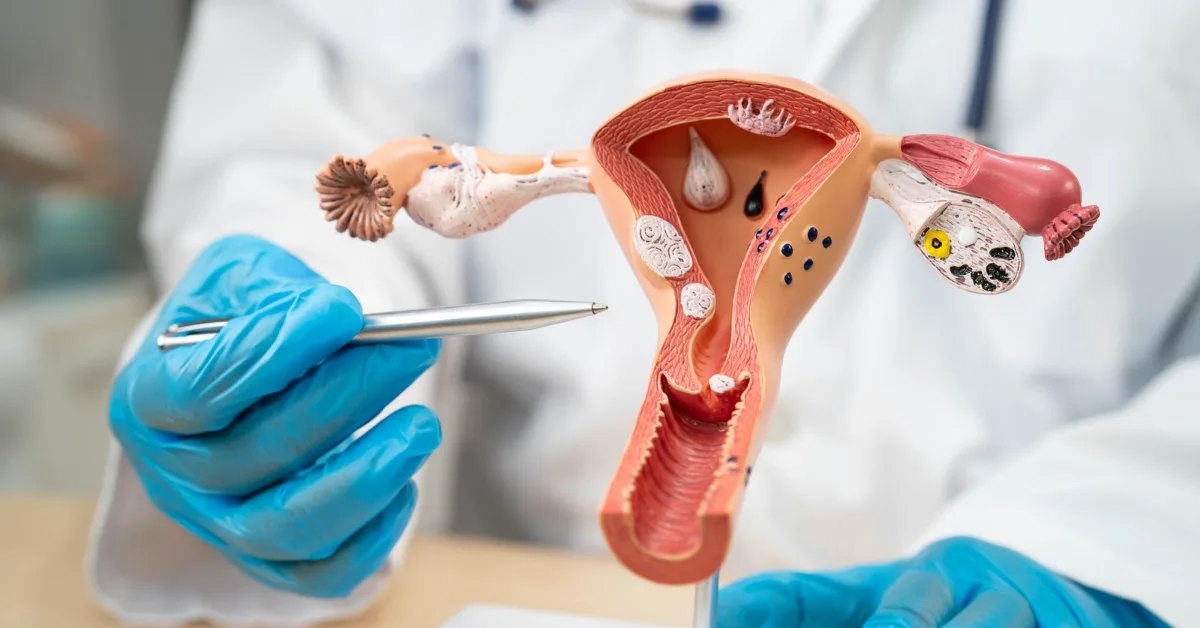 IUI - Intrauterine Insemination